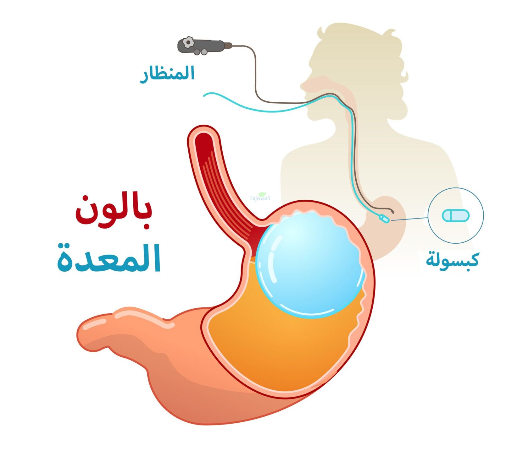 كبسولة المعدة الذكية