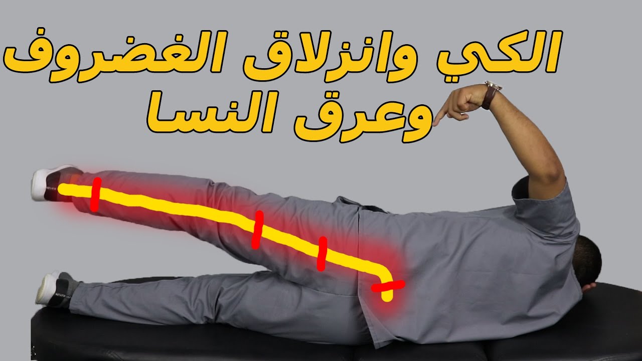 علاج عرق النسا بالكي بالنار