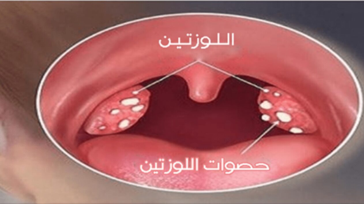 تجربتي مع حصوات اللوز