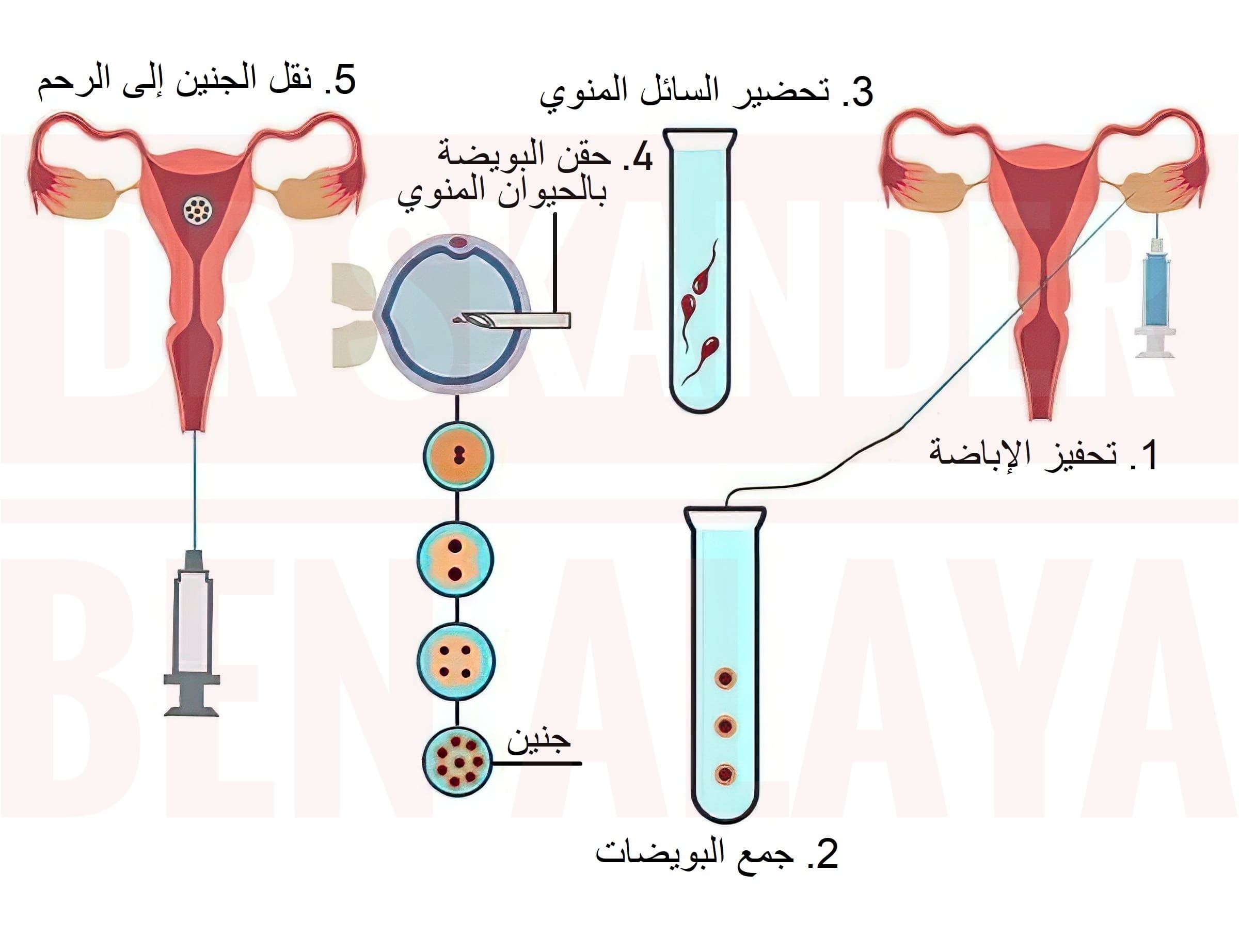 تجربتي في تحديد نوع الجنين بالحقن المجهري