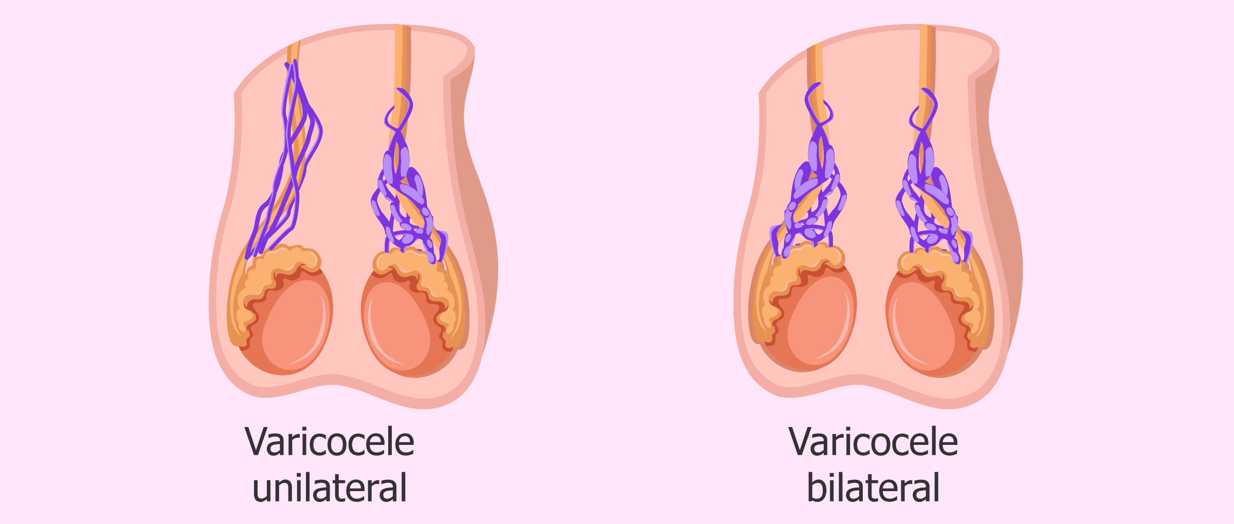 علاج الدوالي الخصية في الطب النبوي