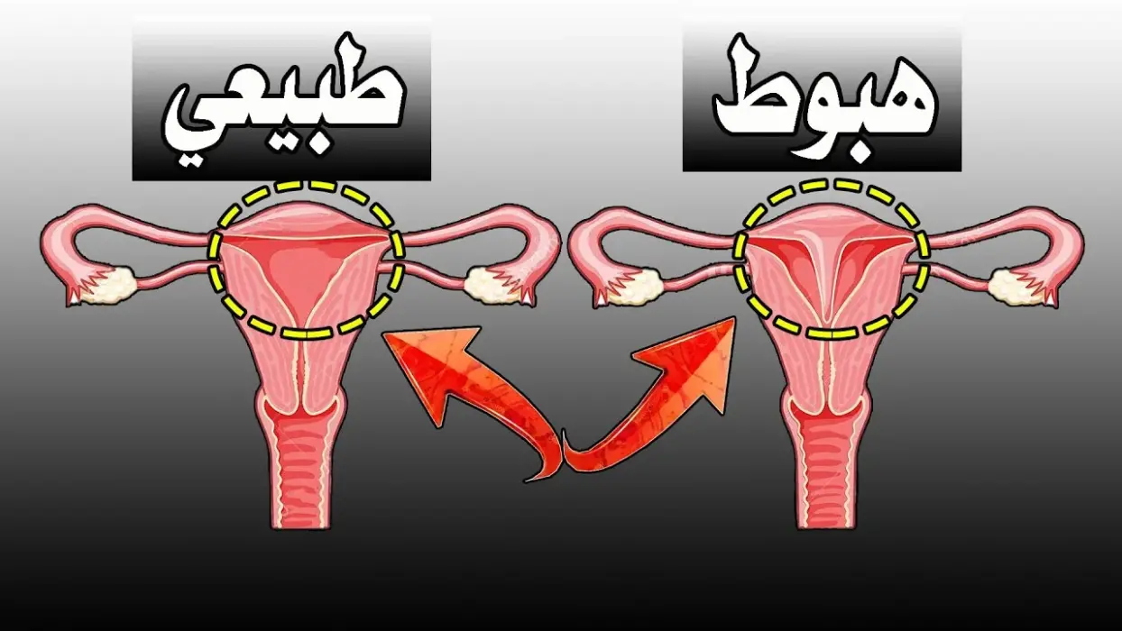 عملية هبوط الرحم بالصور