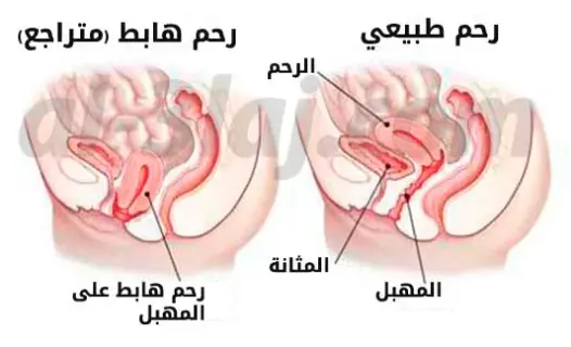 عملية هبوط الرحم بالصور