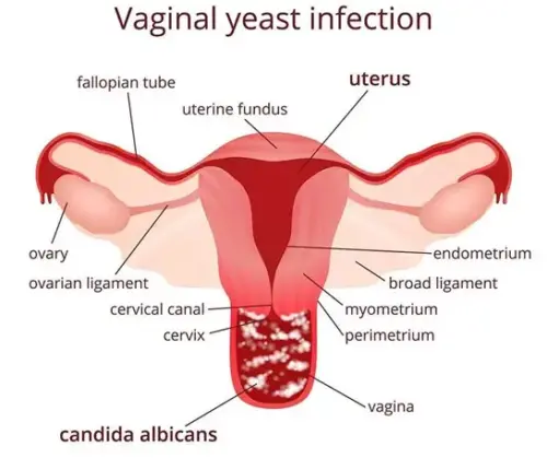 أضرار فطريات المهبل