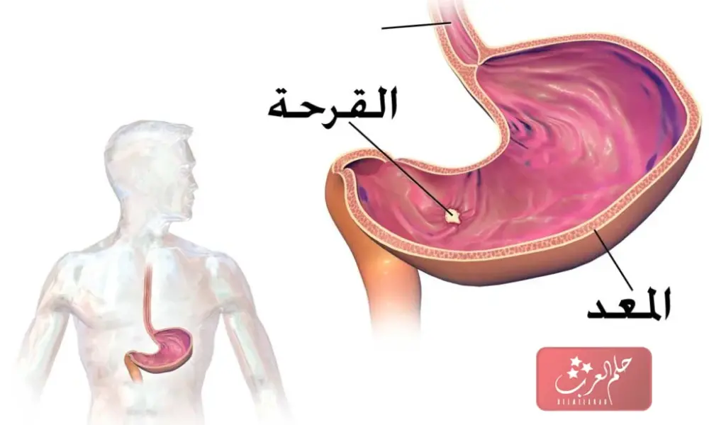 تجربتي مع قرحة الاثني عشر