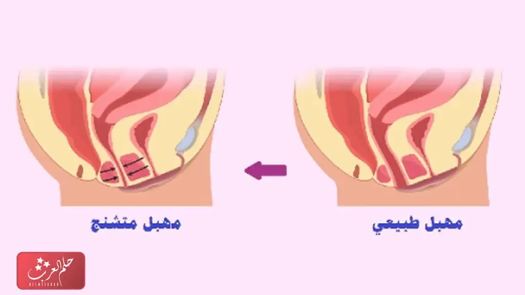 علاج التشنج المهبلي بالقران