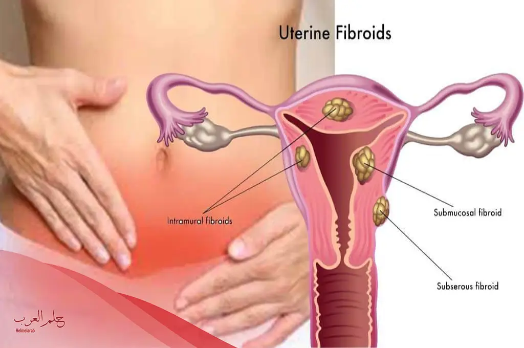 تجربتي في علاج الورم الليفي في الرحم