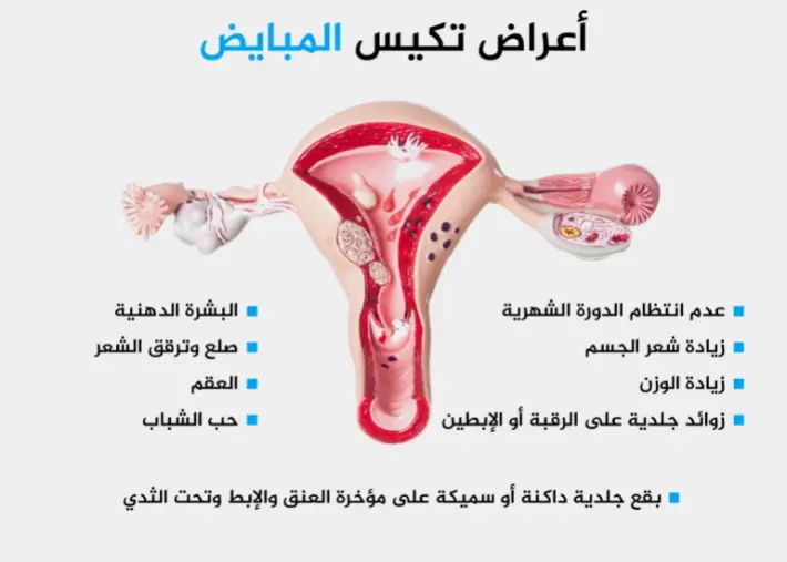 أعراض تكيس المبايض الخفيف