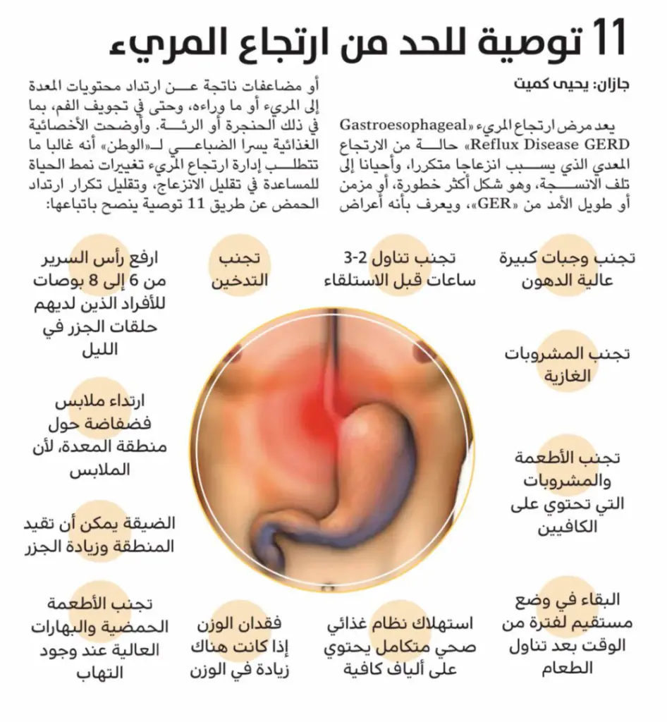 نصائح لتخفيف أعراض ارتجاع المريء النفسية