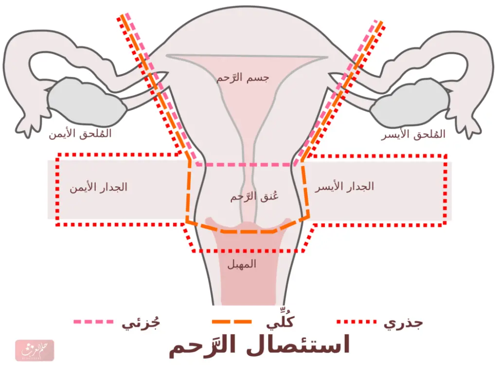 متى يسمح بالجماع بعد استئصال الرحم