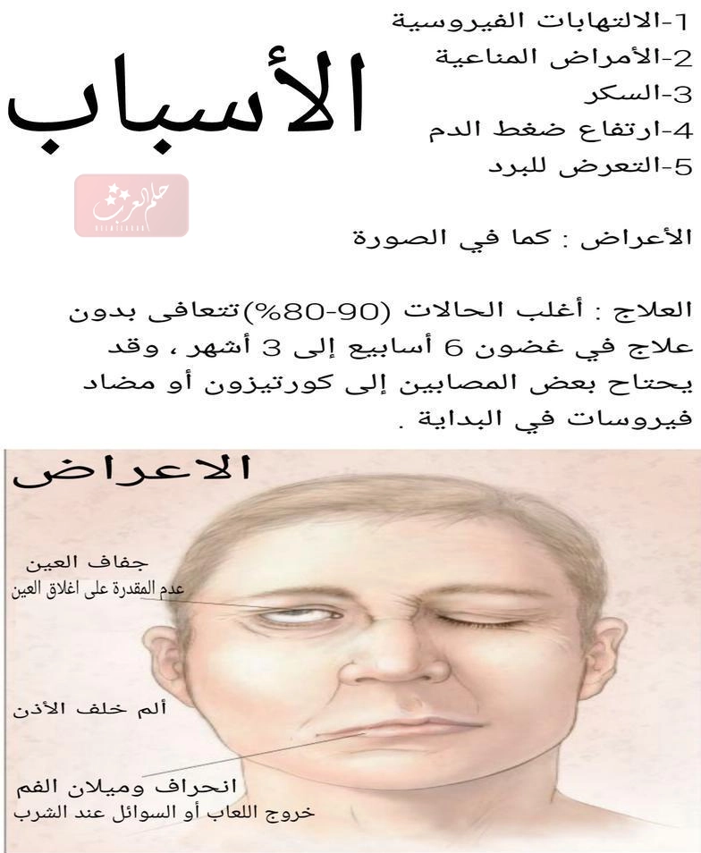 أسباب التهاب العصب السابع