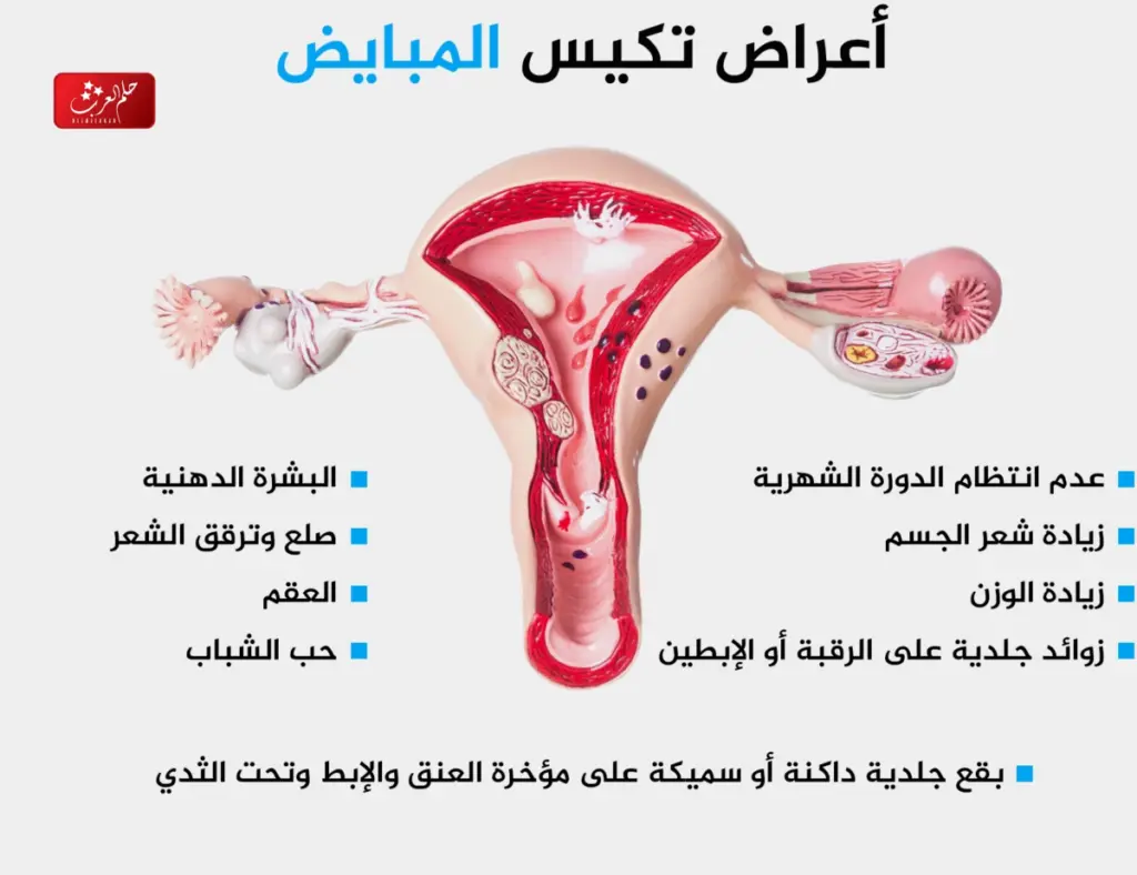 علاج تكيس المبايض