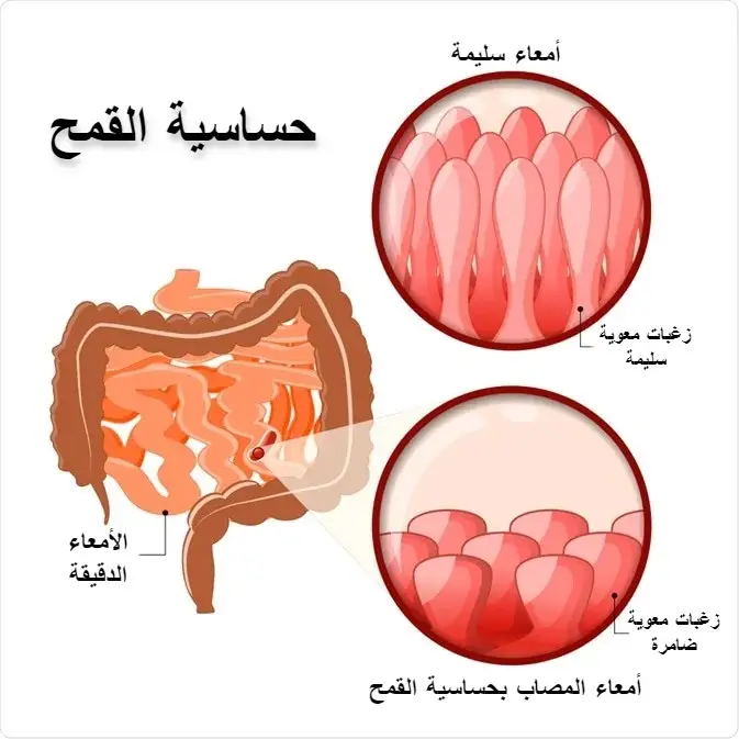 تجربتي مع حساسية القمح