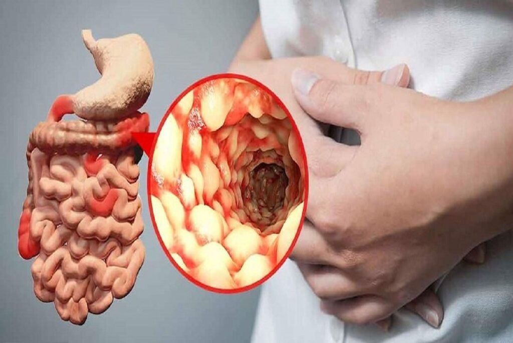 تجربتي مع مرض كرون وأبرز اعراضه وحالات شفيت منه