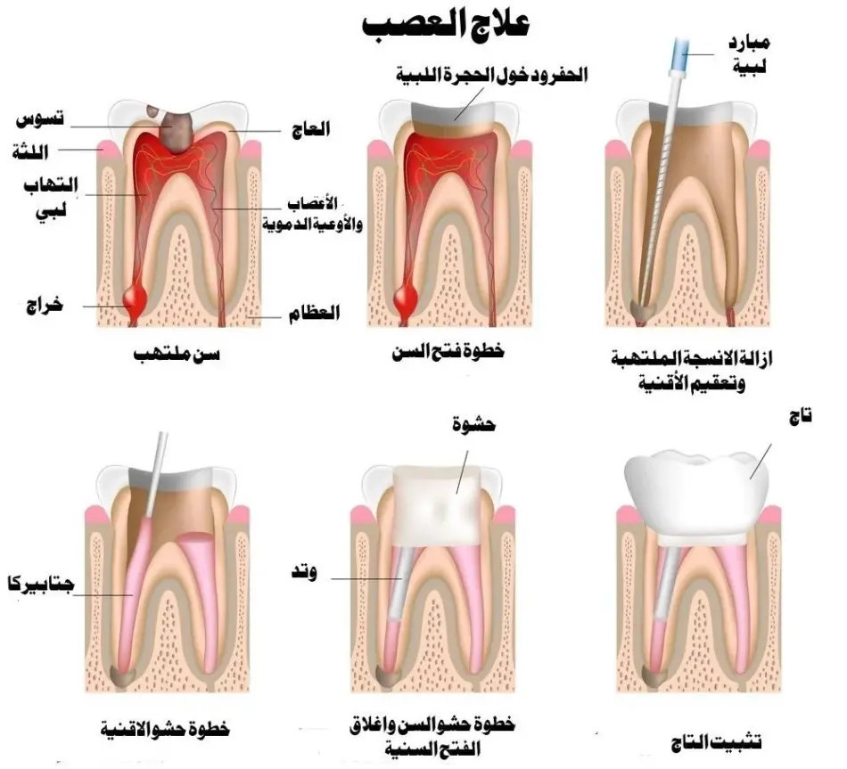 سحب العصب