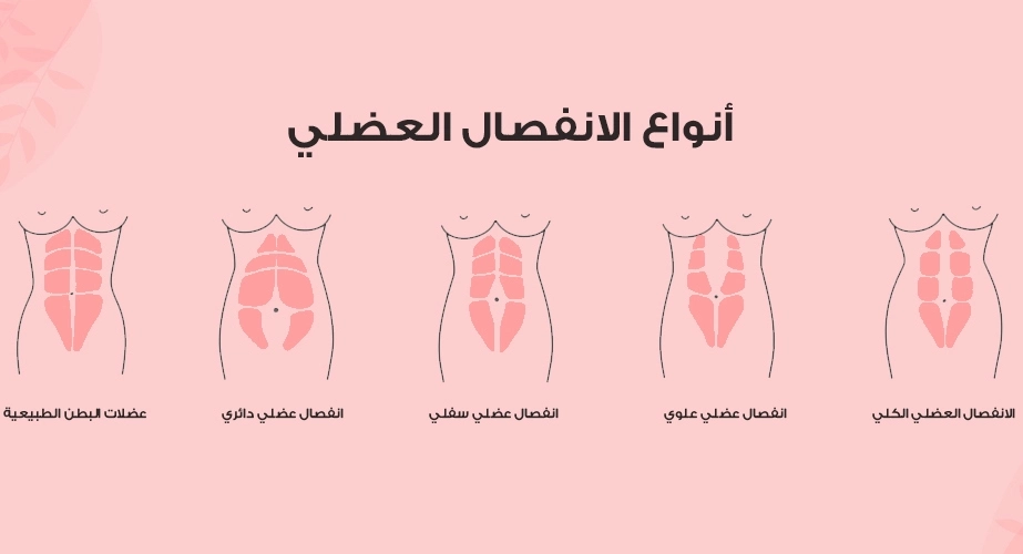 تجربتي مع انفصال عضلات البطن