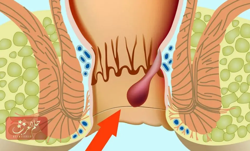 البواسير الخارجية
