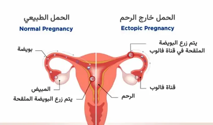 تجربتي مع الحمل خارج الرحم