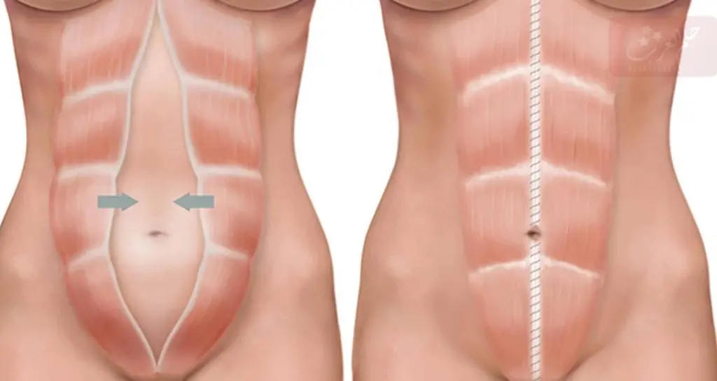 انفصال عضلات البطن Diastasis Recti