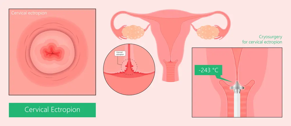 قرحة عنق الرحم