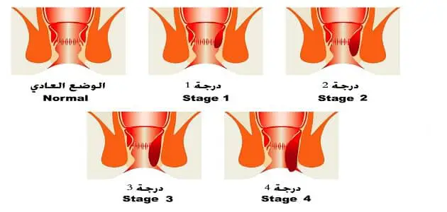 ما هي أخطر مراحل البواسير؟