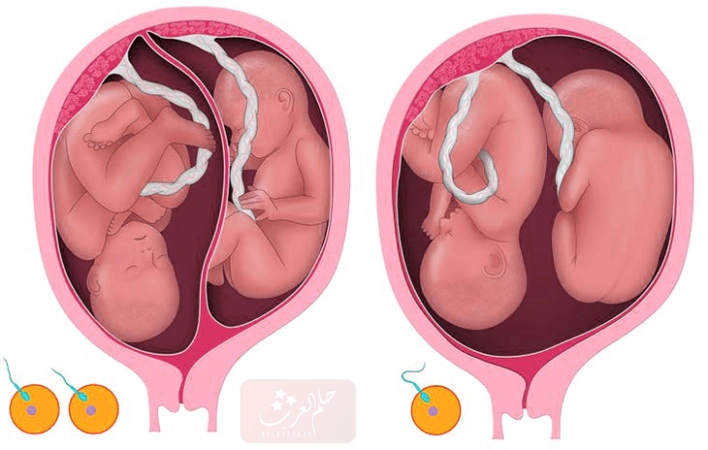 مراحل انقسام البويضة لتشكل التوأم المتماثل