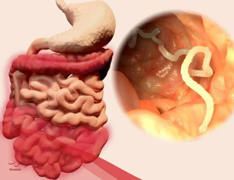 أعراض الديدان عند النساء