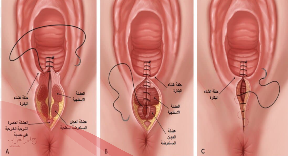 شكل المهبل بعد الولادة بدون خياطة