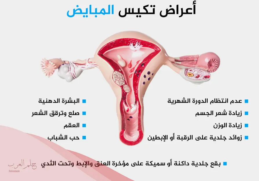 أعراض الحمل مع تكيس المبايض