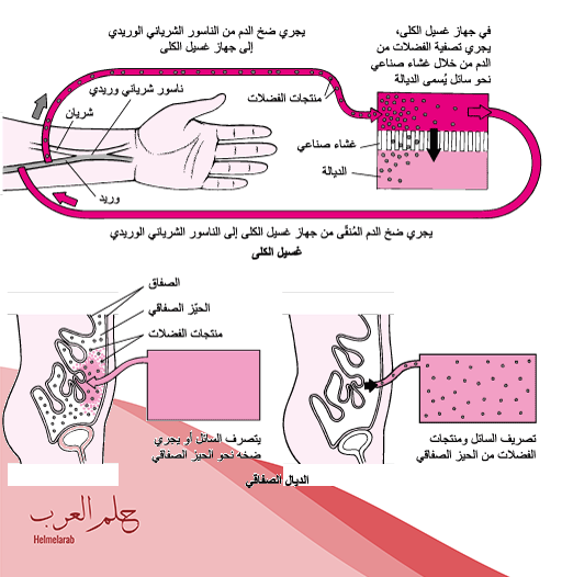 تجربتي مع الغسيل البريتوني