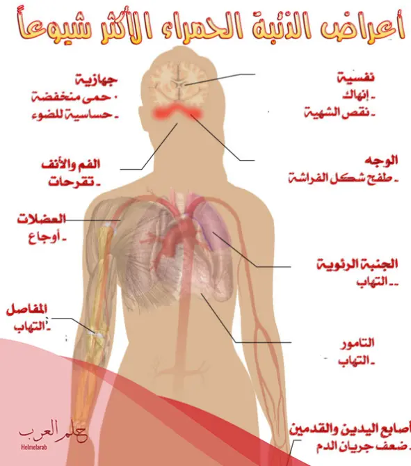 تجربتي مع الذئبة الحمراء