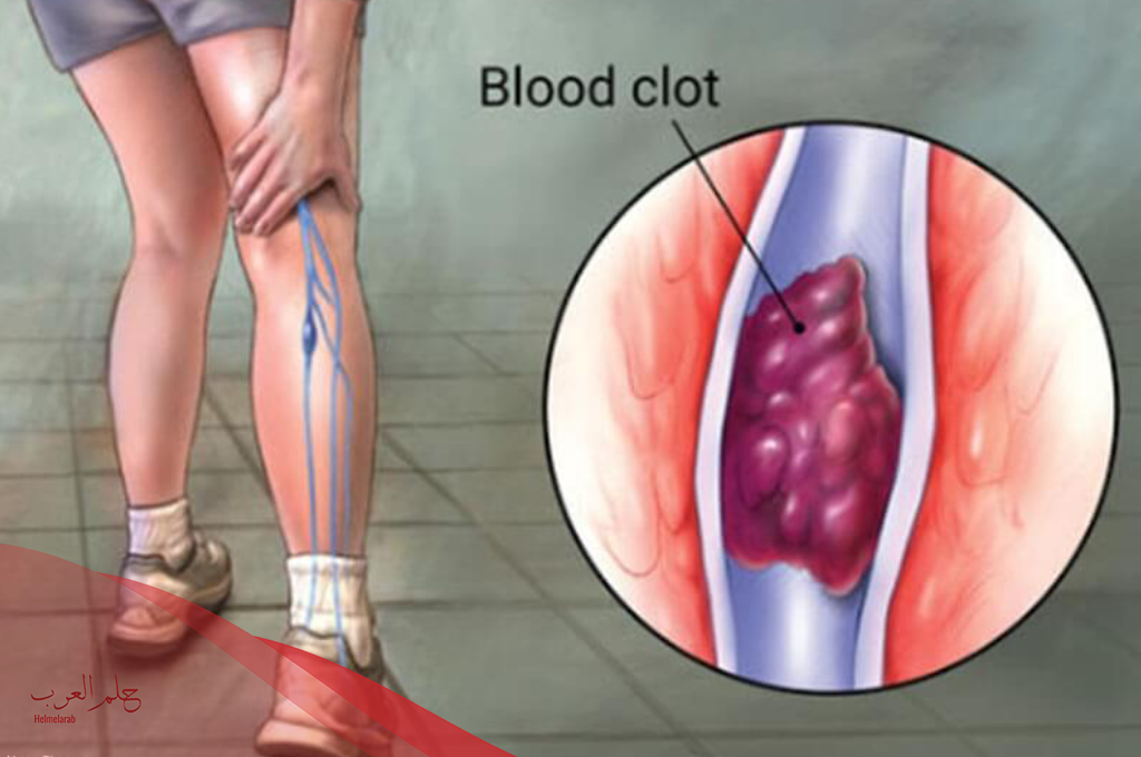 أعراض جلطة الساق السطحية