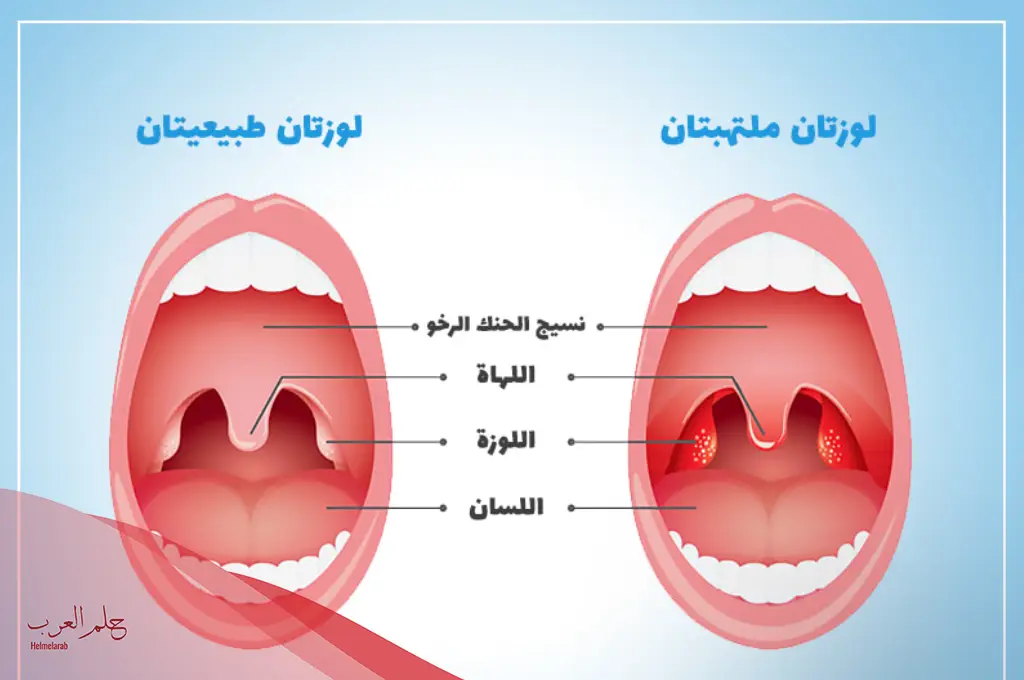 تجربتي مع استئصال اللوزتين وما سلبياتها