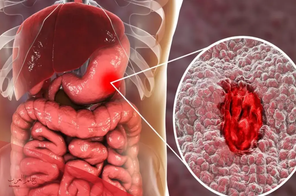 تجربتي في علاج قرحة المعدة عالم حواء
