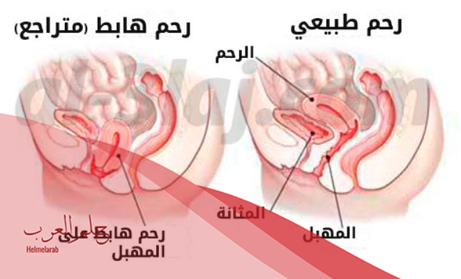 الآثار الجانبية لعملية رفع المثانة