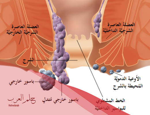 شكل البواسير بعد الولادة