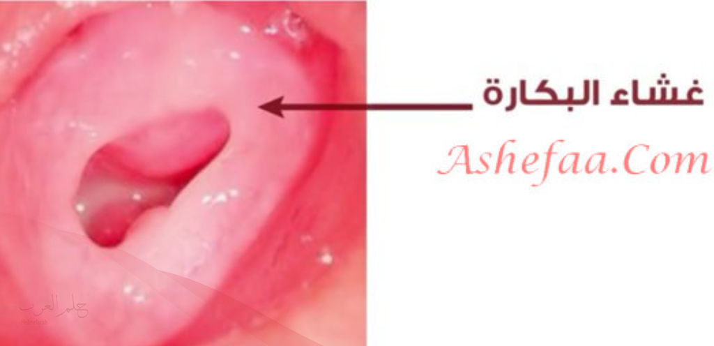 شكل اللحمة الوردية في المهبل