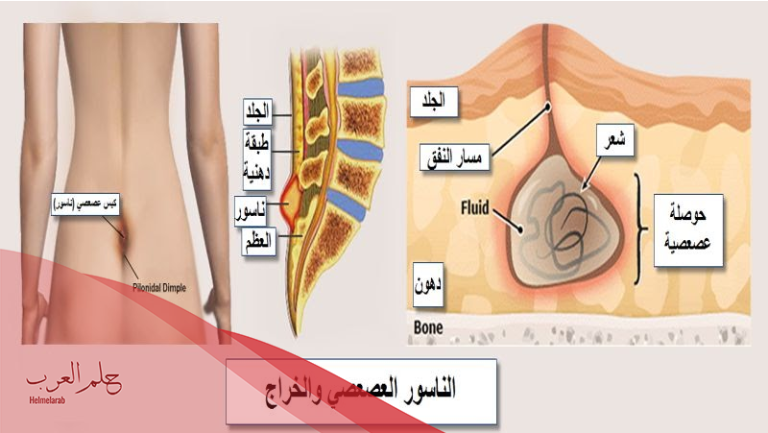 علاج الناسور مجرب