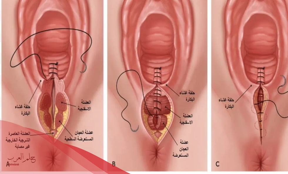 علامات التئام جرح العملية القيصرية عالم حواء