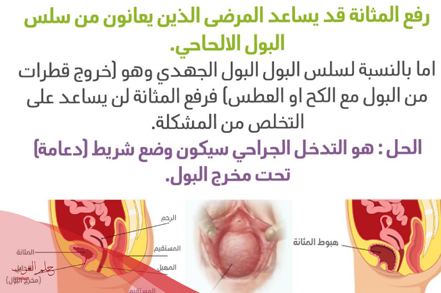 كم تستغرق عملية رفع المثانة؟