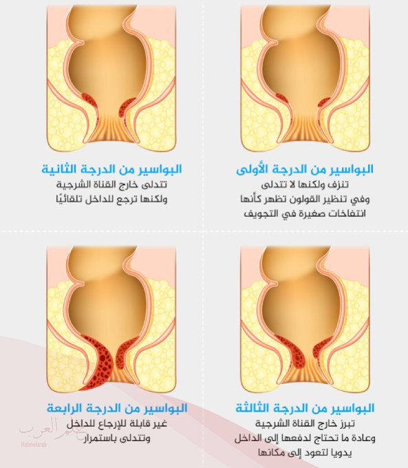 كيف أعرف البواسير