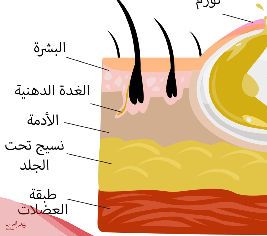 هل الكيس الدهني يختفي ويظهر