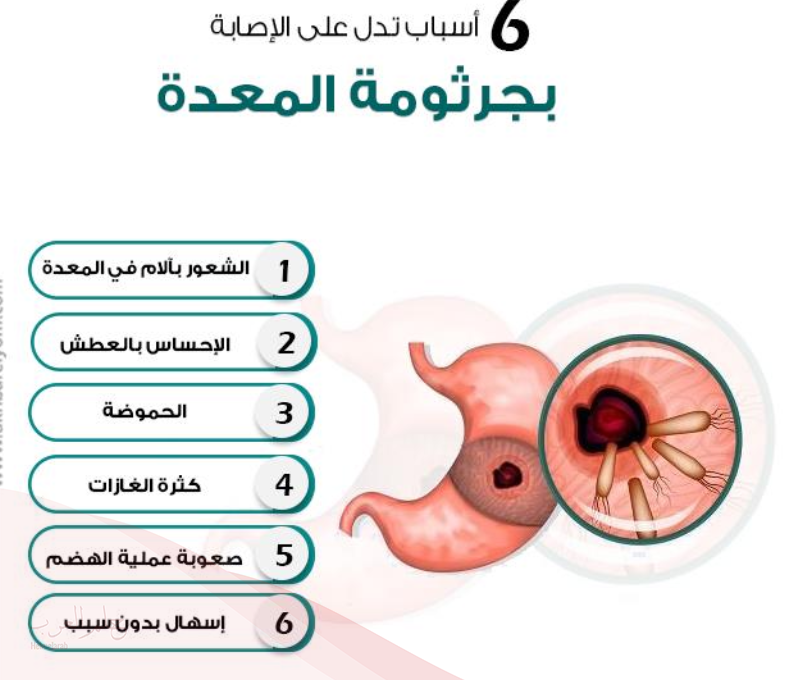 أسباب الإصابة بجرثومة المعدة