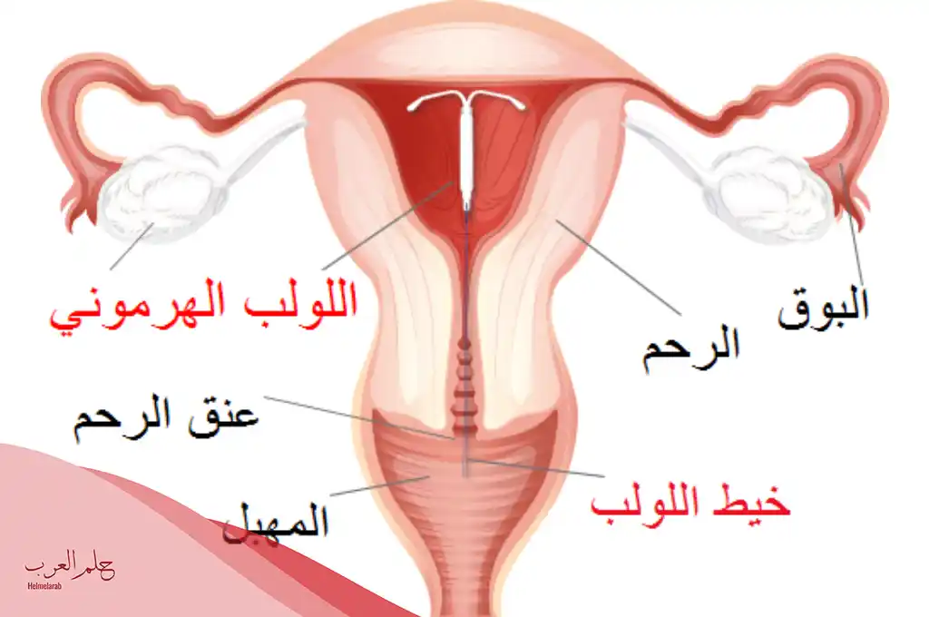 الفرق بين اللولب الهرموني والنحاسي