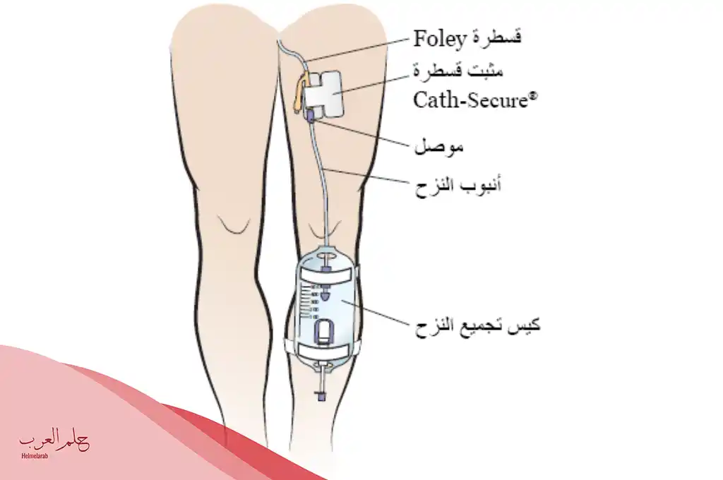 إزالة القسطرة البولية للنساء