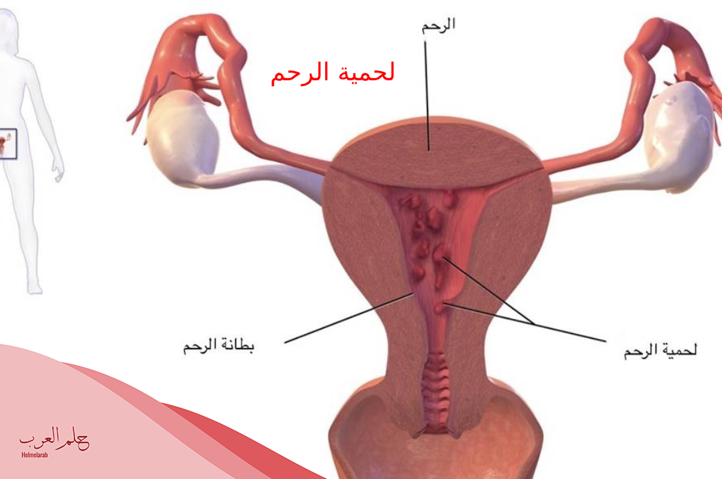 اختفاء لحمية الرحم