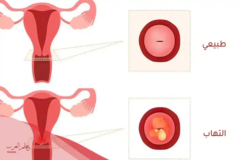 متى يكون الرحم مفتوح أثناء الدورة