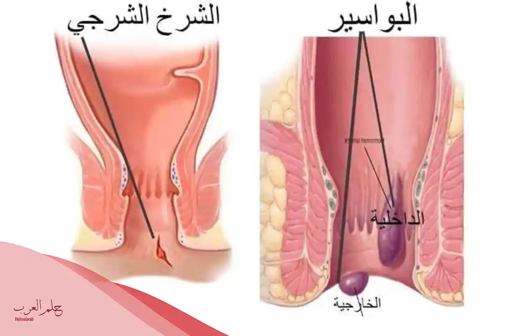 أفضل علاج للشرخ عن تجربة