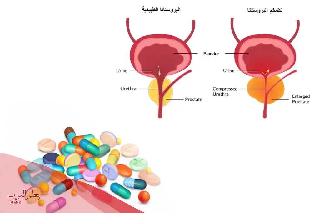 ما افضل مضاد حيوي لعلاج التهاب البروستاتا عند الرجل