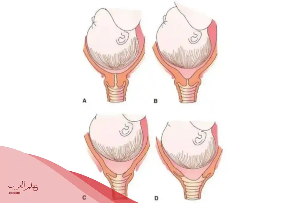 ما هي اسباب نزول الجنين في الحوض؟